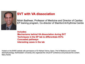 SVT with VA dissociation