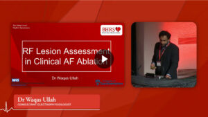 SESSION 5c: RF Lesion assessment in clinical AF ablation - Dr Waqas Ullah